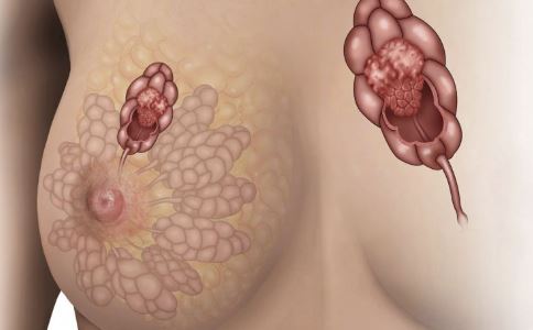 這些癥狀是乳腺癌前兆 5招預防乳癌