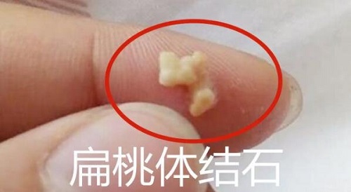 一招讓扁桃體結石自己排出來怎么做 扁桃體結石脫落小妙招有哪些
