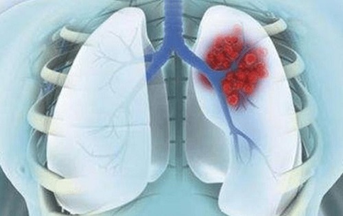 肺癌晚期最怕三個(gè)征兆是什么 哪些身體癥狀表示進(jìn)入肺癌晚期