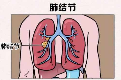 肺部結節(jié)要吃藥嗎 肺部有結節(jié)可以治愈嗎