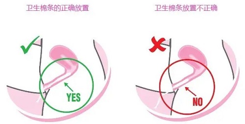 衛(wèi)生棉條怎么用步驟 女生使用衛(wèi)生棉條需要注意什么