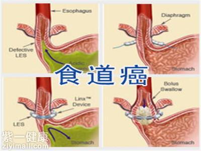 食道癌早期癥狀是什么 食道癌和咽炎最大區別是什么