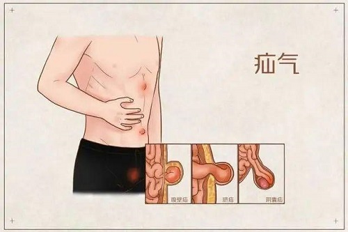 疝氣的癥狀和治療是什么 疝氣能過夫妻生活嗎
