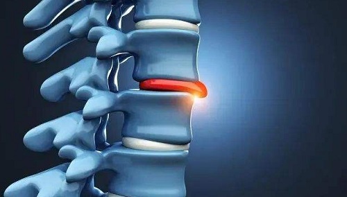 腰椎突出嚴(yán)重怎么辦 腰椎突出可以過(guò)性生活嗎