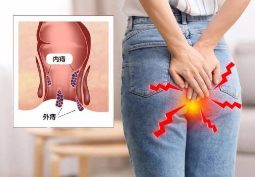 怎么區分痔瘡出血和腸道出血 如何判斷自己長了痔瘡
