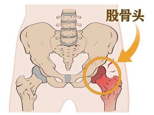 股骨頭壞死早期癥狀是什么 股骨頭壞死的并發癥有哪些