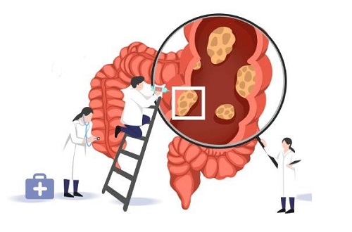 腸癌最明顯的一個征兆是什么 腸癌是怎樣造成的