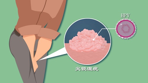 尖銳正常人多久能治愈 男性濕銳尖會(huì)自愈嗎