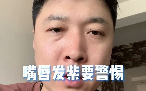嘴唇發(fā)紫是什么原因 嘴唇發(fā)紫是身體哪里不好