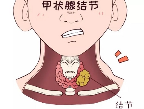 甲狀腺結(jié)節(jié)怎么治療最好 甲狀腺結(jié)節(jié)是怎么引起的