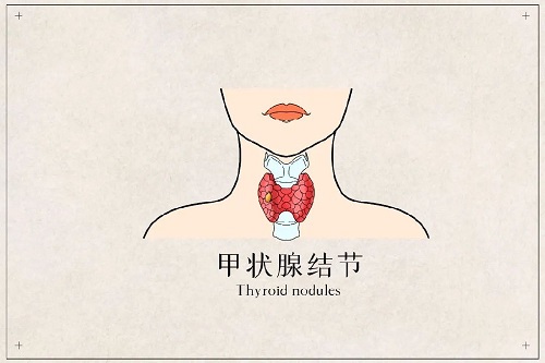 甲狀腺結(jié)節(jié)怎么治療最好 甲狀腺必吃五種水果是什么