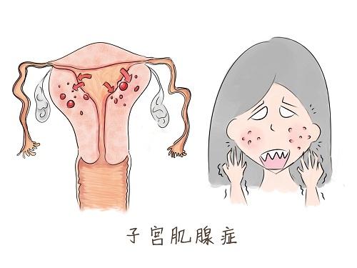 肌腺癥需要手術嗎 肌腺癥手術后多久能懷孕
